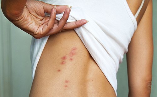 Аллергия на клещей домашней пыли: симптомы и лечение кожи (в том числе у детей)