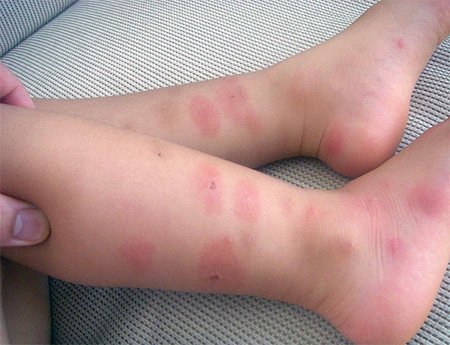 Аллергия на укусы клопов у детей и взрослых: как выглядит и как лечить