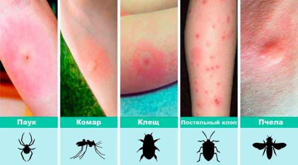Аллергия на укусы клопов у детей и взрослых: как выглядит и как лечить