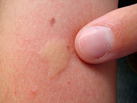 Аллергия на укусы комаров у взрослых и детей