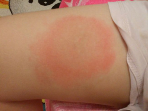 Аллергия на укусы комаров у детей и взрослых: симптомы (фото), как вылечить аллергическую реакцию