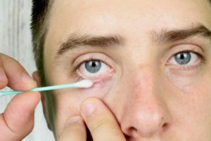 Демодекоз глаз: лечение и признаки, как избавиться, лучшие капли и народные средства