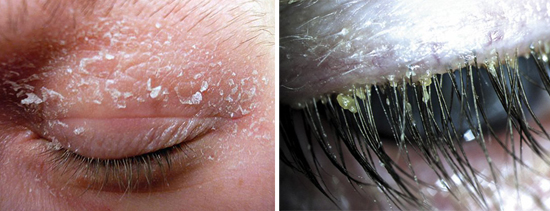 Демодекоз у человека на лице: фото, медикаментозное лечение, симптомы