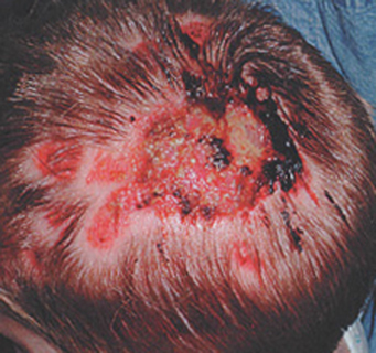 Демодекоз волосистой части головы: лечение и последствия