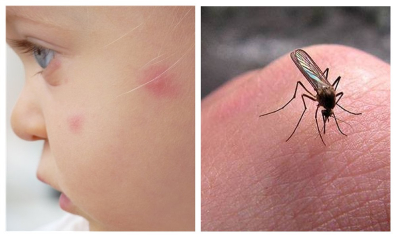 Есть явный признак того, как отличить укус комара от нападения клопа