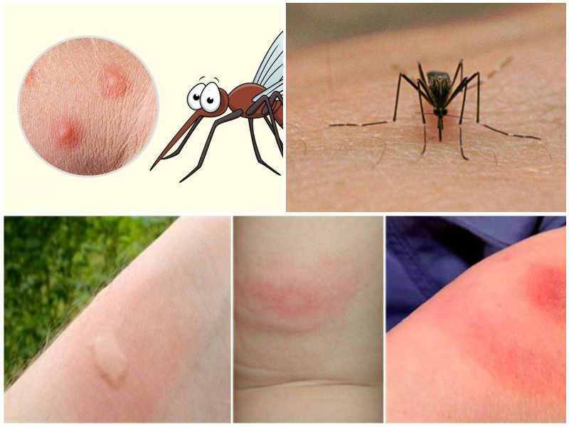 Как избавиться от укусов комаров: бороться с зудом и пятнами