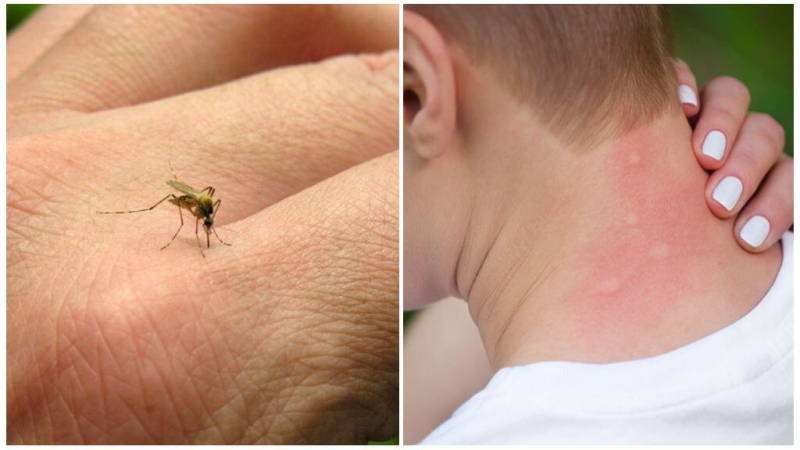 Чем лечить укус комара у ребенка, как снять отек и устранить последствия. Первая медицинская помощь