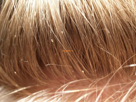 Как отличить перхоть от гнид в волосах: методы, позволяющие не спутать гнид с перхотью