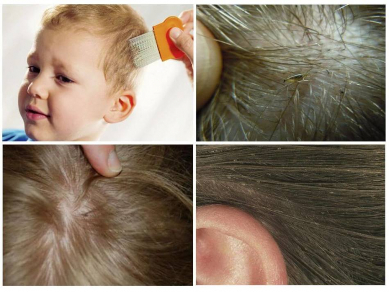 Как отличить перхоть от гнид в волосах: методы, позволяющие не спутать гнид с перхотью