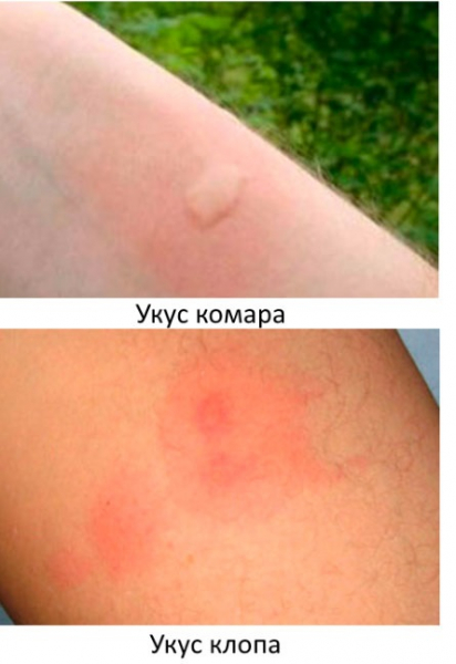 Как отличить укус комара от укуса насекомого или клеща
