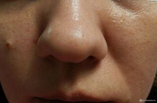 Подкожный клещ на лице: симптомы и лечение, народные и аптечные средства