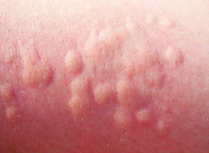 Укус малярийных комаров – отек, пятна, аллергия и зуд от укусов комаров, чем их мазать?