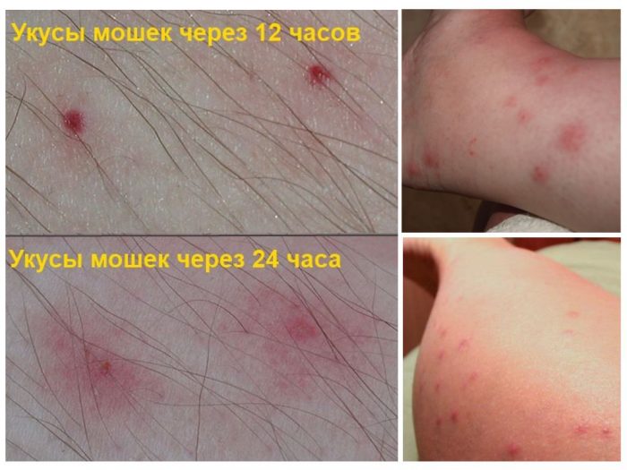 Укус комара: фото, симптомы и лечение, сколько длятся укусы
