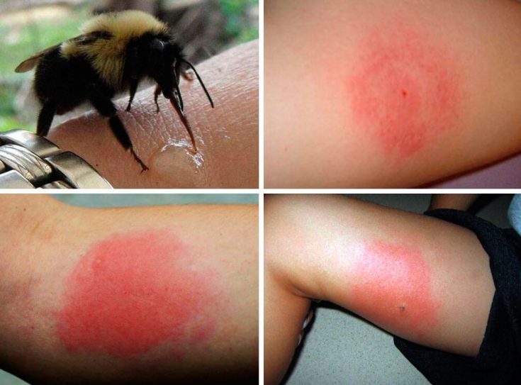 Укус шмеля и его последствия: что делать в домашних условиях, если вас укусило опасное насекомое?