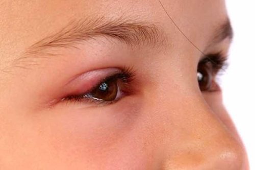 Укусила мошка в глаз: отечность и опухоль глаз: как снять и что делать, если укусил ребенок