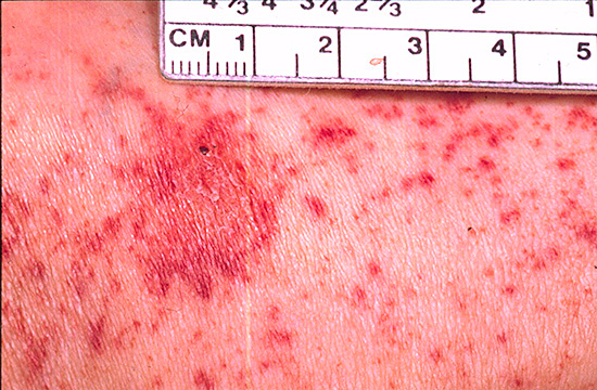 Заболевания, вызванные укусом клеща: признаки у человека